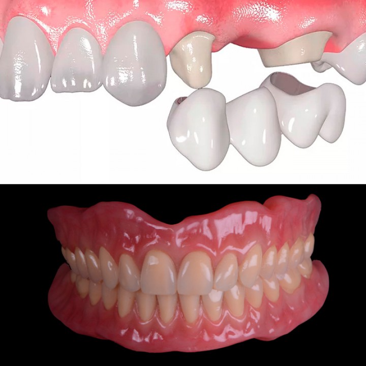Foto Tratamento Próteses Dentárias Próteses Dentárias