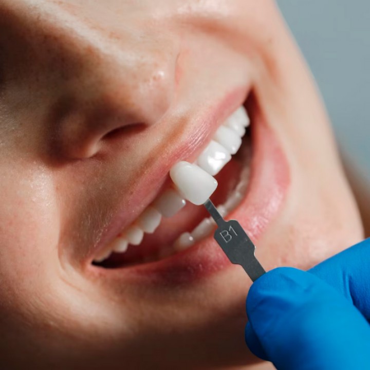 Foto Tratamento Facetas e Lentes de Contato Facetas e Lentes de Contato